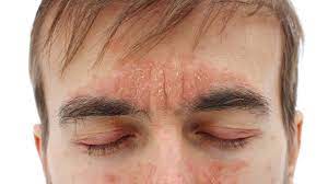 dermatitis seborreica cara piel sana