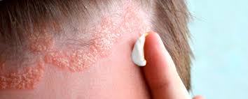 dermatitis seborreica cuero cabelludo piel sana