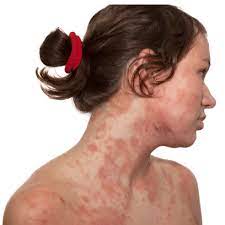 Dermatitis seborreica cuerpo