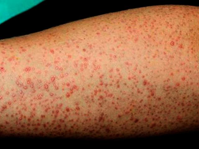 Mujer con piel sensible observando su brazo, símbolo del cuidado natural y enfoque integrativo del liquen plano desde la dermonutrición.