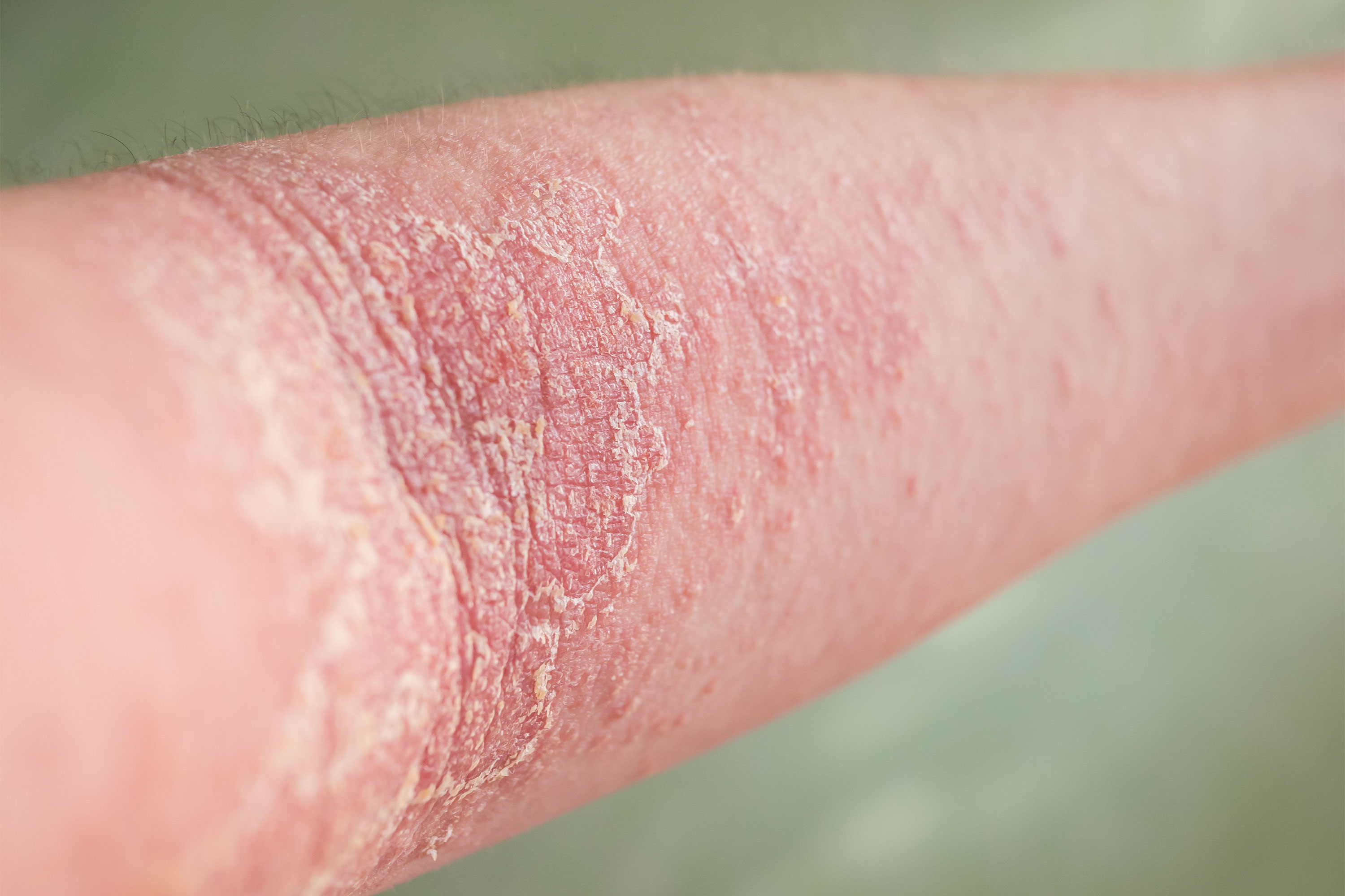 Primer plano de dermatitis atópica en el brazo, con enrojecimiento, sequedad y descamación visibles, ejemplo de inflamación cutánea tratada desde la dermonutrición.