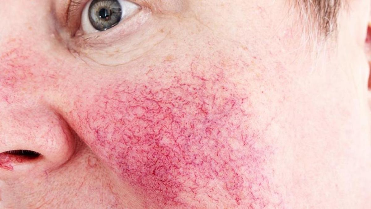 Primer plano de mejilla con rosácea, enrojecimiento y vasos dilatados, ejemplo de piel sensible e inflamada que puede mejorar con un enfoque de dermonutrición.