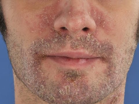 Primer plano de rostro con dermatitis seborreica, mostrando enrojecimiento y descamación alrededor de la nariz y la boca, ejemplo de piel inflamada tratada desde la dermonutrición.
