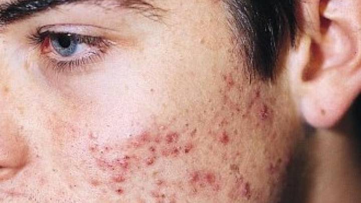 Primer plano de mejilla con acné inflamatorio y pústulas rojas, ejemplo de piel afectada por desequilibrio hormonal e intestinal tratada desde la dermonutrición.