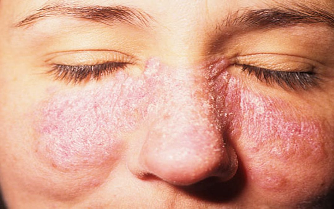 Erupción facial de lupus eritematoso cutáneo en forma de mariposa sobre mejillas y nariz, ejemplo de inflamación autoinmune abordada desde la dermonutrición.