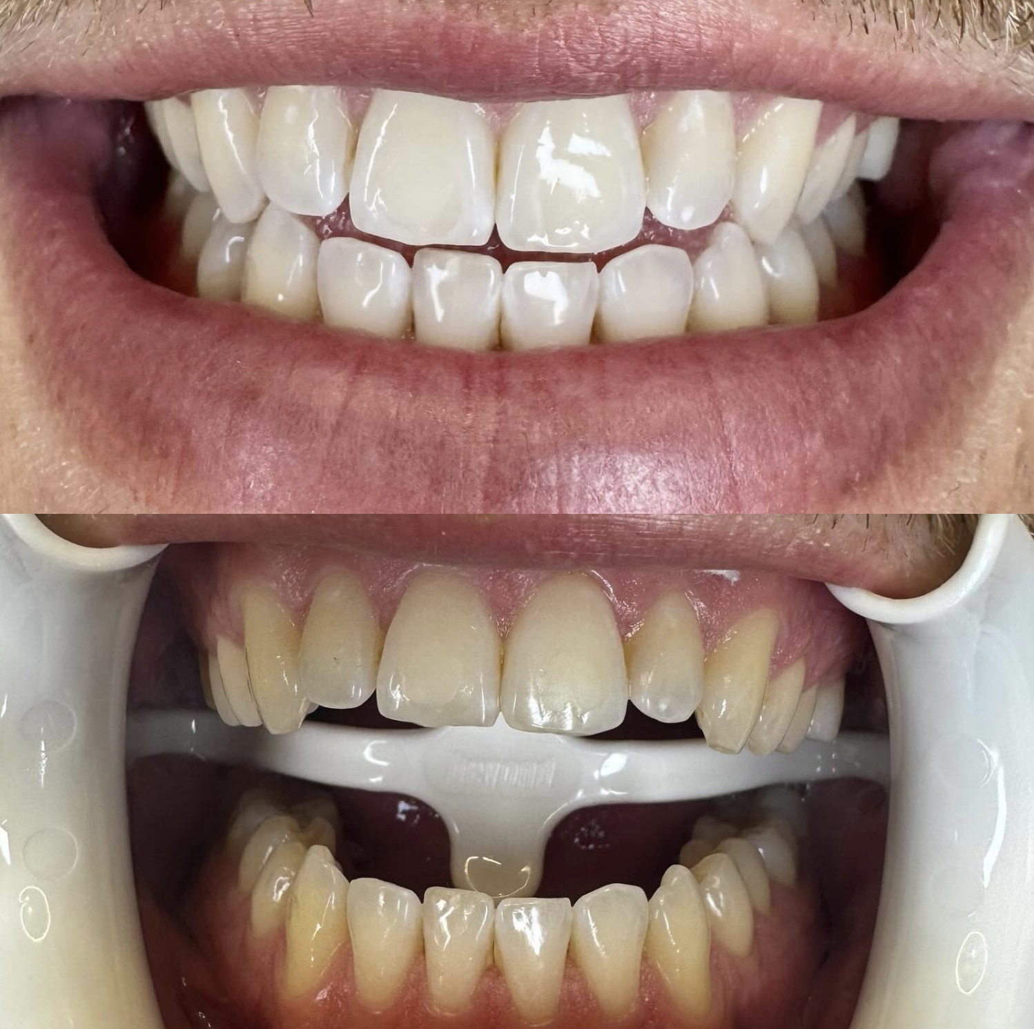 Before and After Teeth Whitening Results