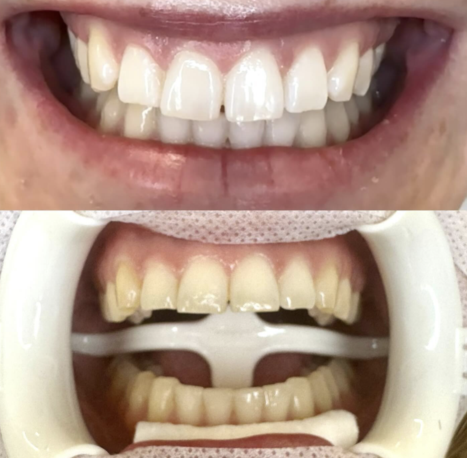 Before and After Teeth Whitening Results