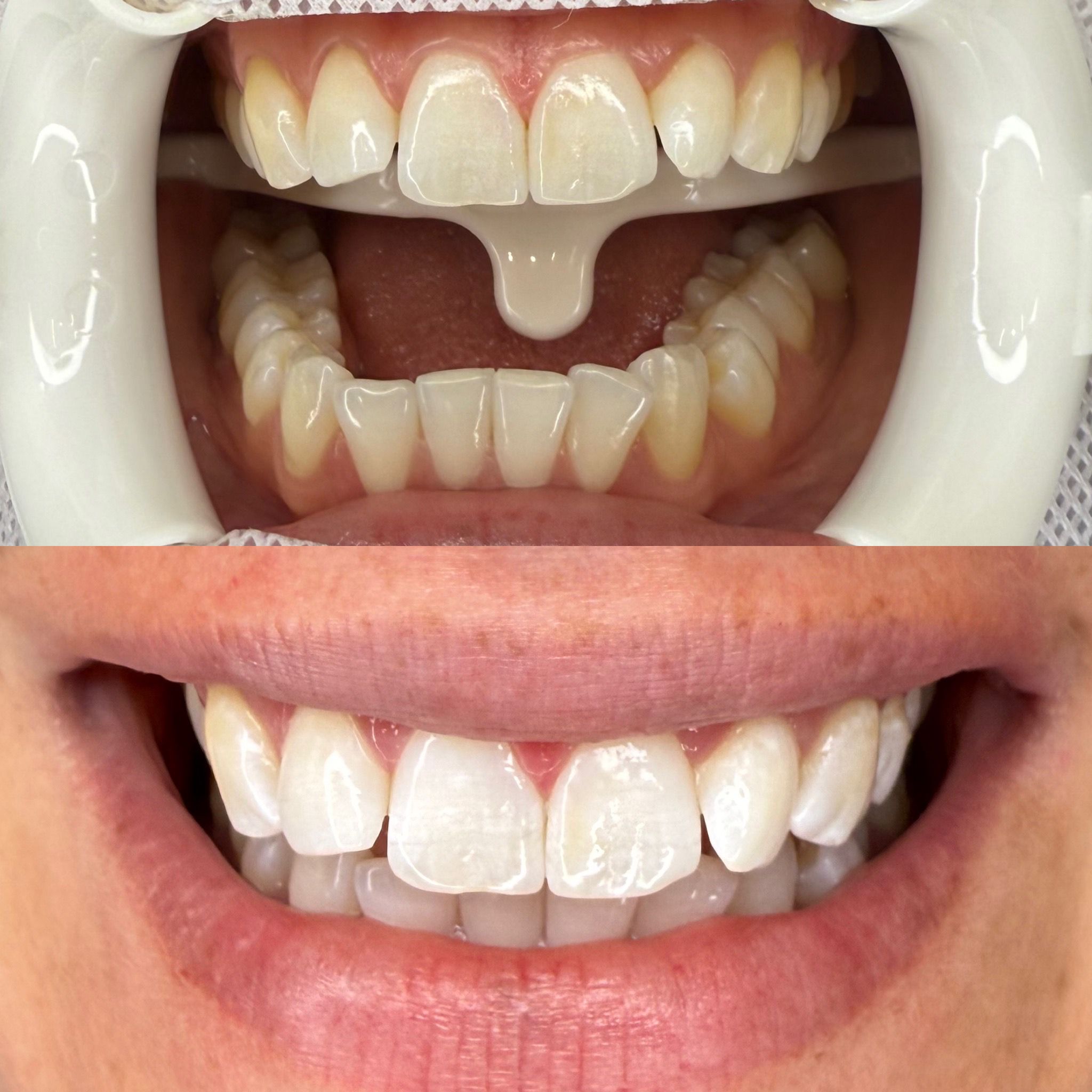 Professional Teeth Whitening Results