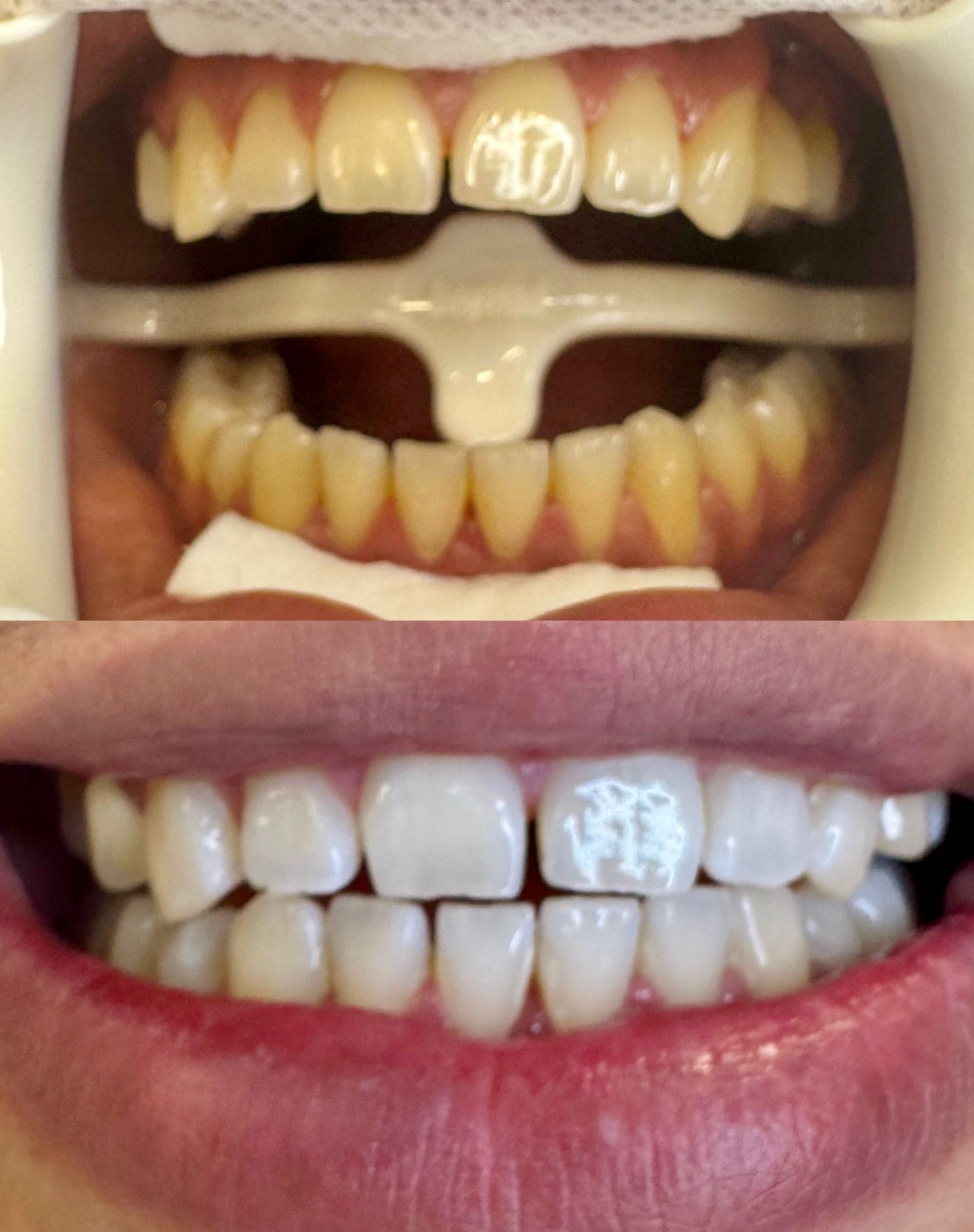 Before and After Teeth Whitening Results