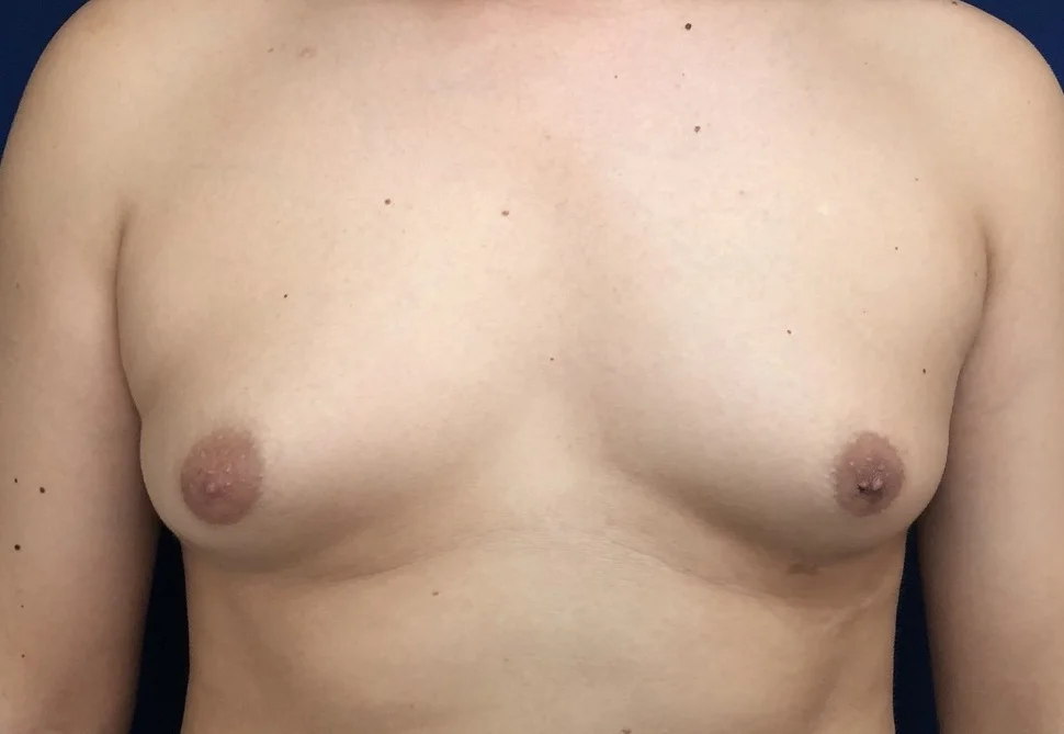 Antes 1 Ginecomastia