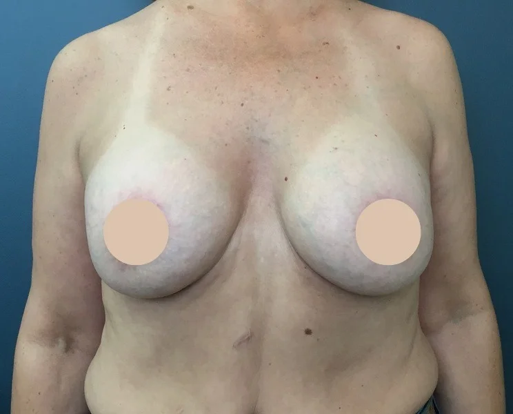 Después 4 Frontal Mastopexia