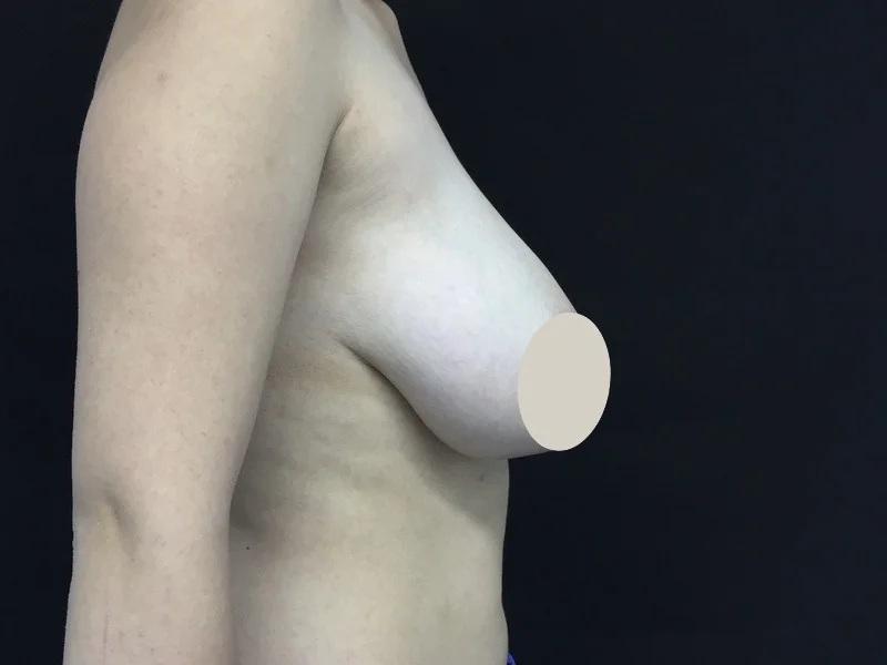 Antes 5 Lateral Reducción