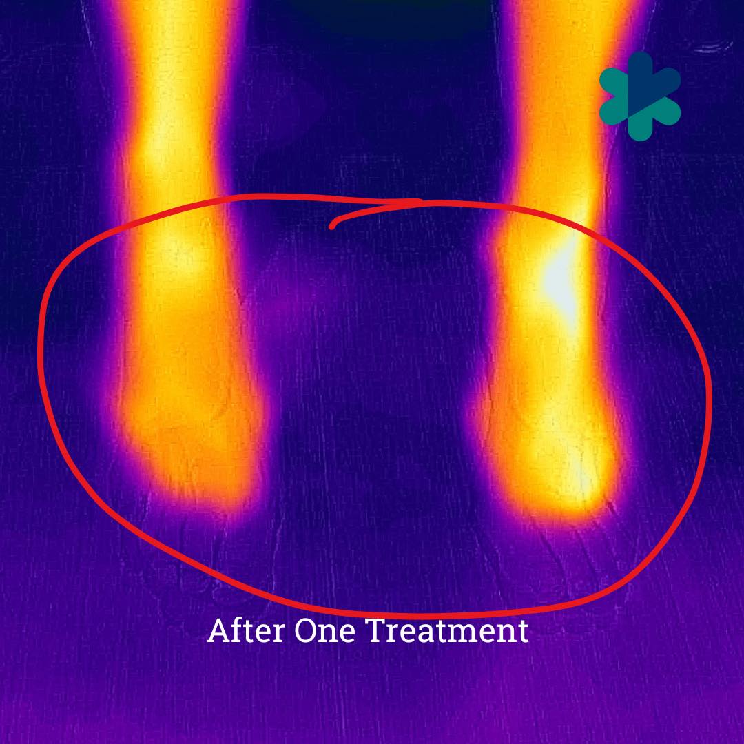After One Neuropathy Treatment