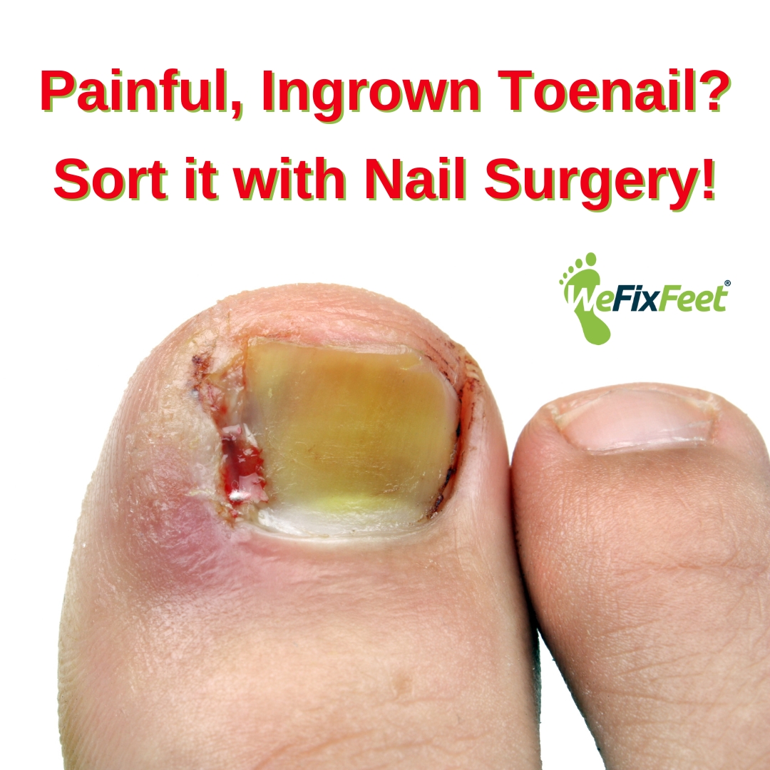 Painful Ingrown Toenail before Nail Surgery at We Fix Feet