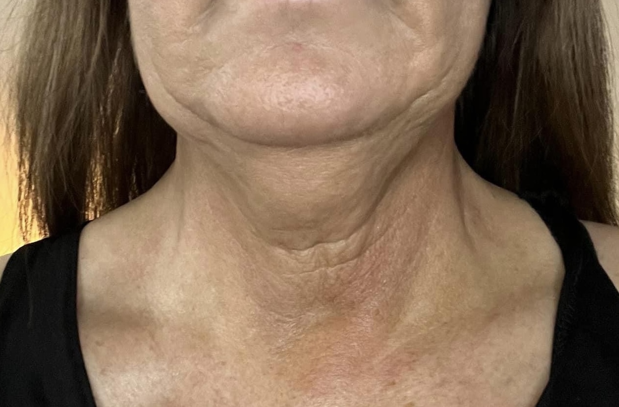 neck before