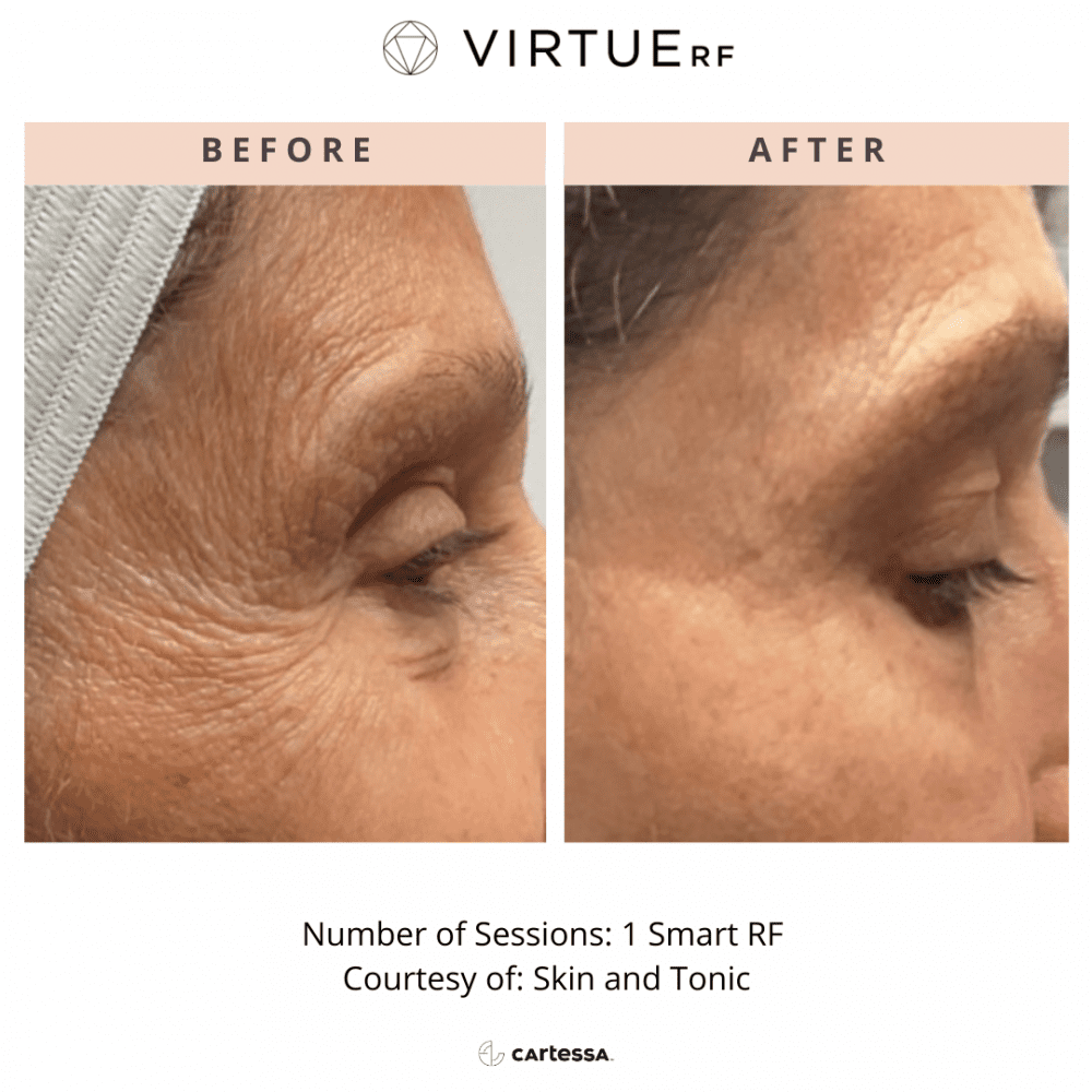 Discover the Power of Virtue Microneedling