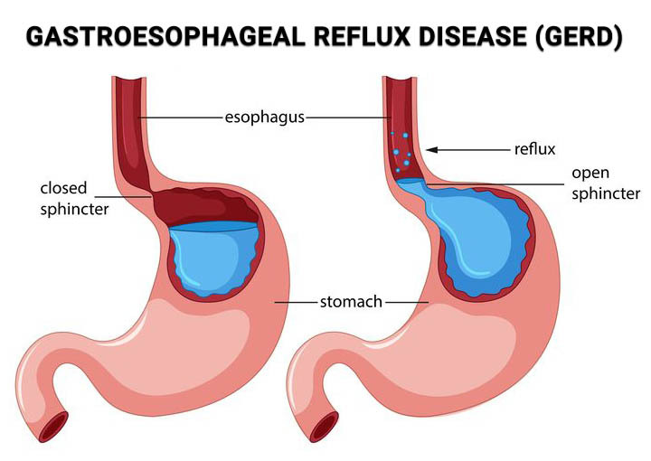 Natural Treatment For Acid Reflux