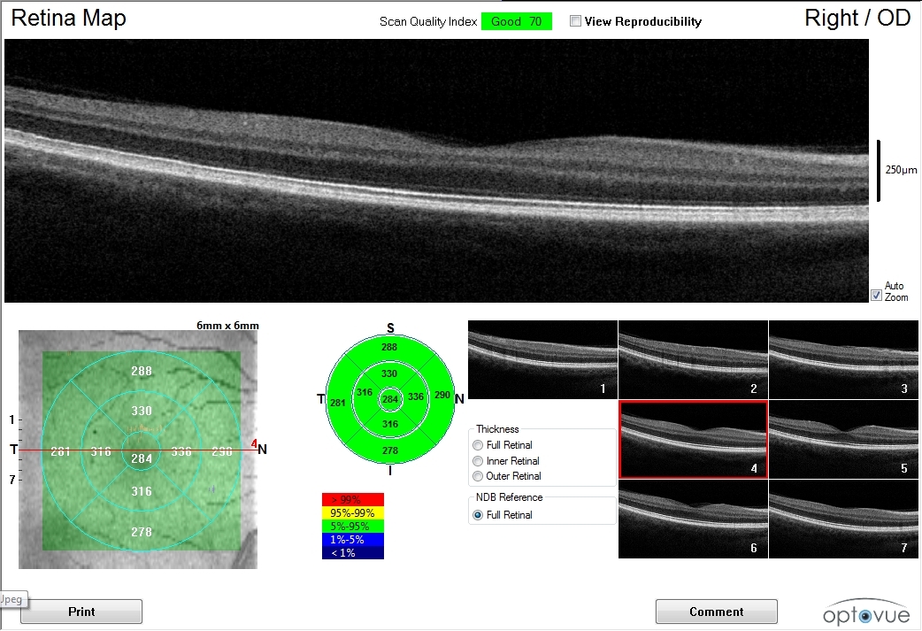 OCT retinal imaging technology for advanced eye disease detection in San Francisco