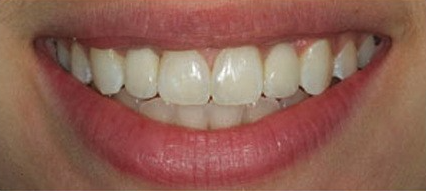 The patient now have a perfect smile after dental implant