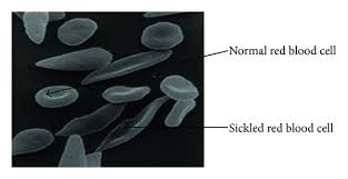 Normal and Sickled red blood cell