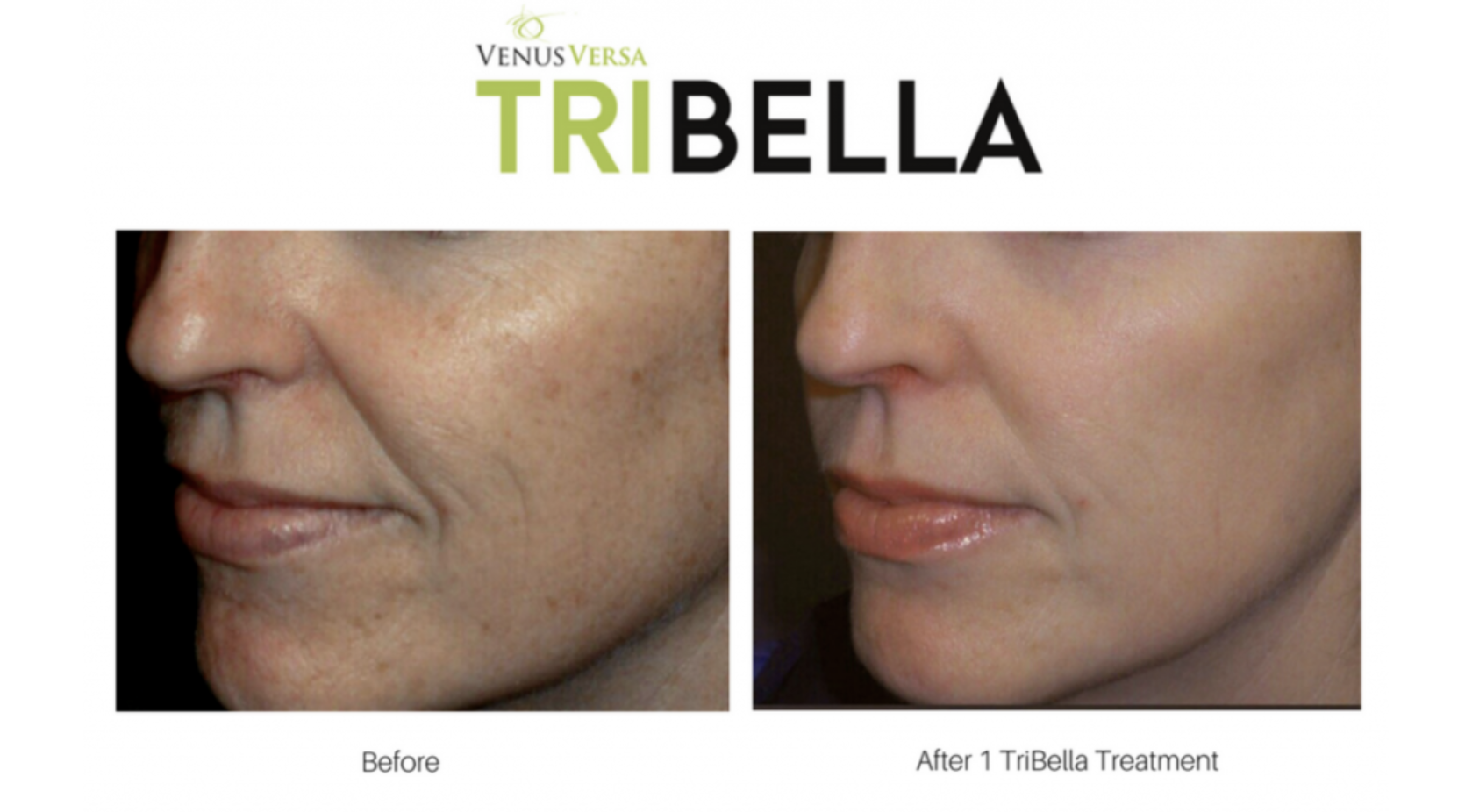 Tribella treatment before and after photo Tribella treatment before and after photo