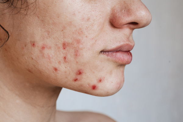 Acne Acne