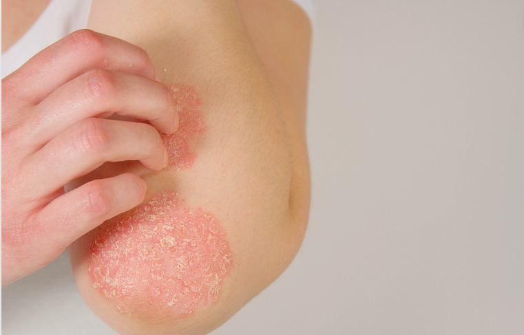 Eczema Eczema