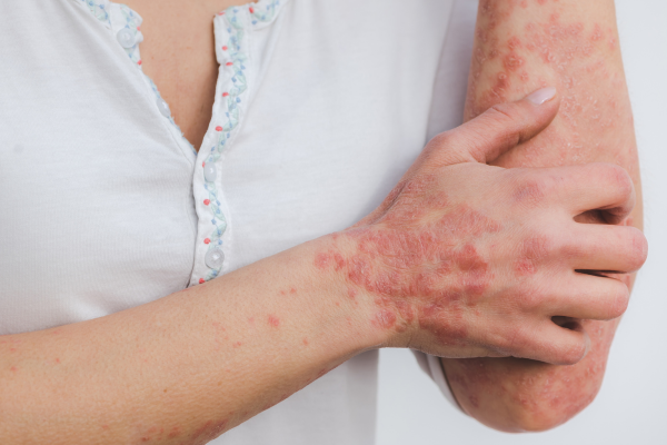 Psoriasis Psoriasis