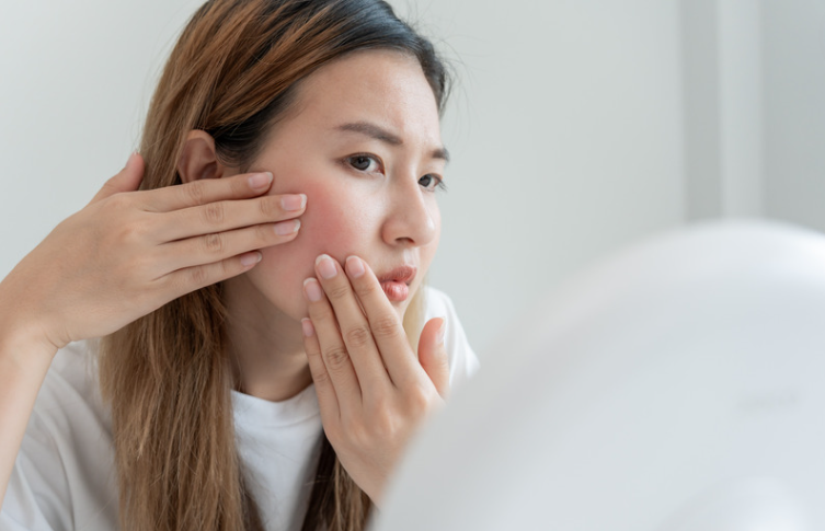 Rosacea Rosacea