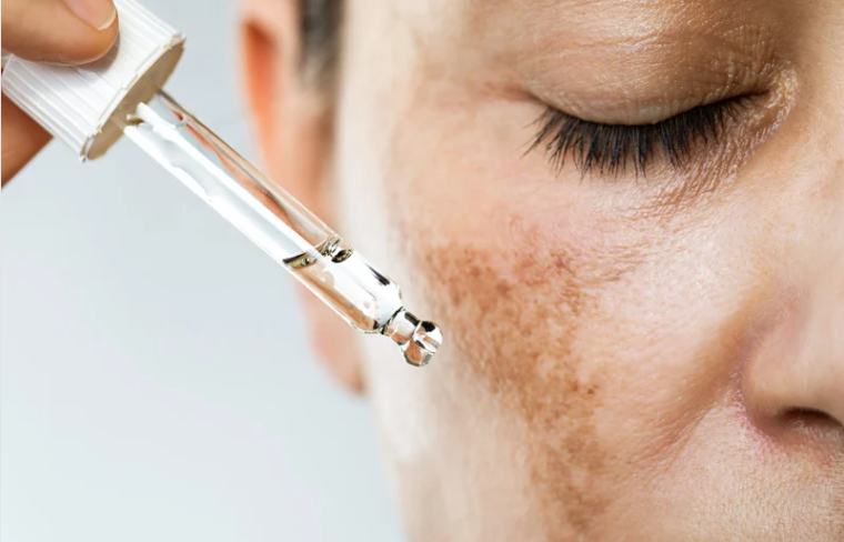 Melasma Melasma