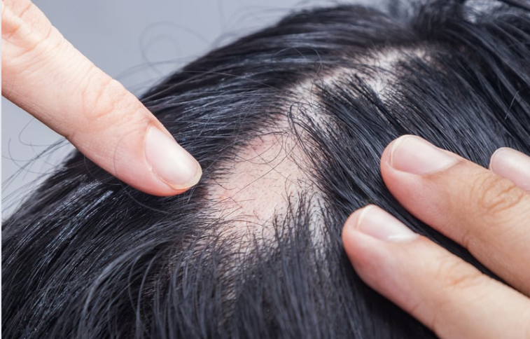 Alopecia Areata Alopecia Areata