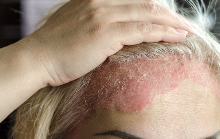 Seborrheic Dermatitis Seborrheic Dermatitis