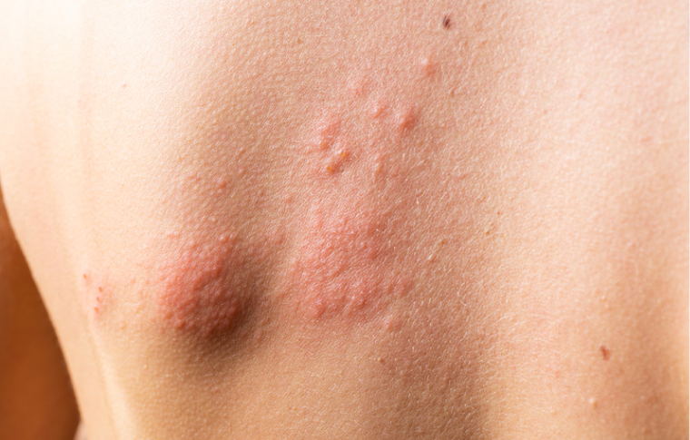 Hives (Urticaria) Hives (Urticaria)