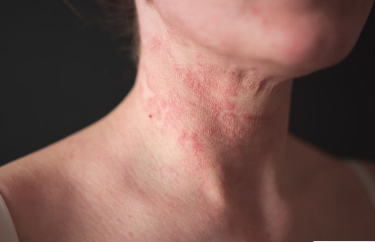 Contact Dermatitis Contact Dermatitis