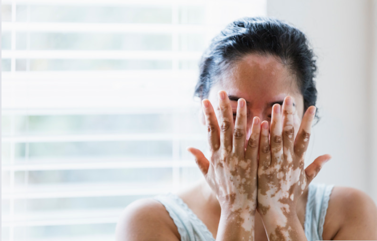 Vitiligo Vitiligo