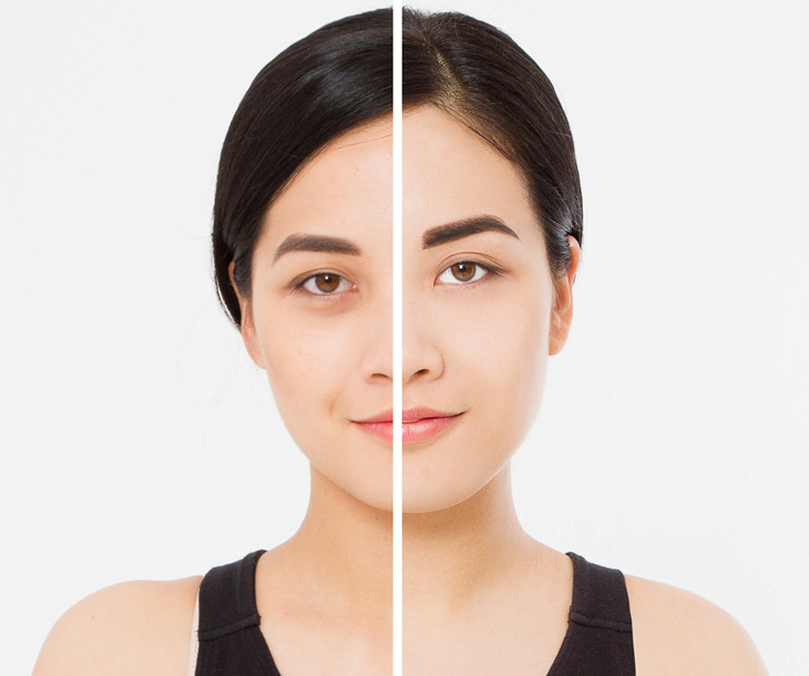 Botox Before and After