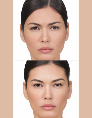 Before-and-after results of wrinkle-relaxing injections treatment at One8Clinic in Melrose Arch, Sandton, showing reduction of frown lines and smoother forehead for a refreshed, natural appearance.