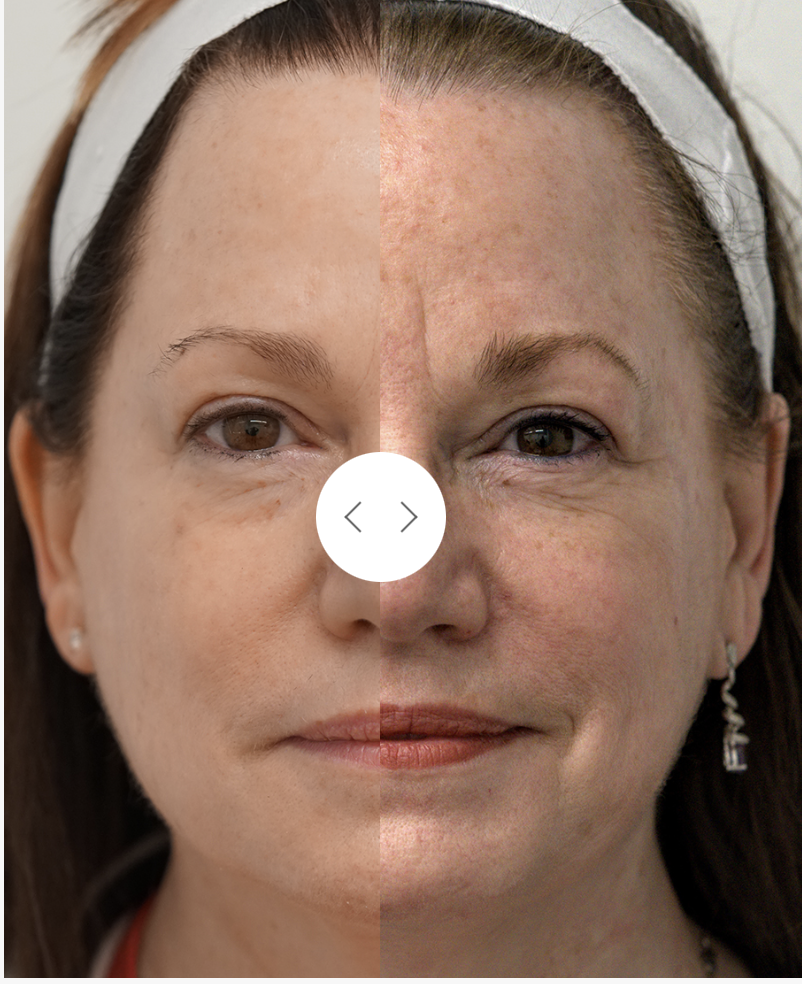 Before and after facial laser treatment showing improvement in skin texture, tone, and fine lines