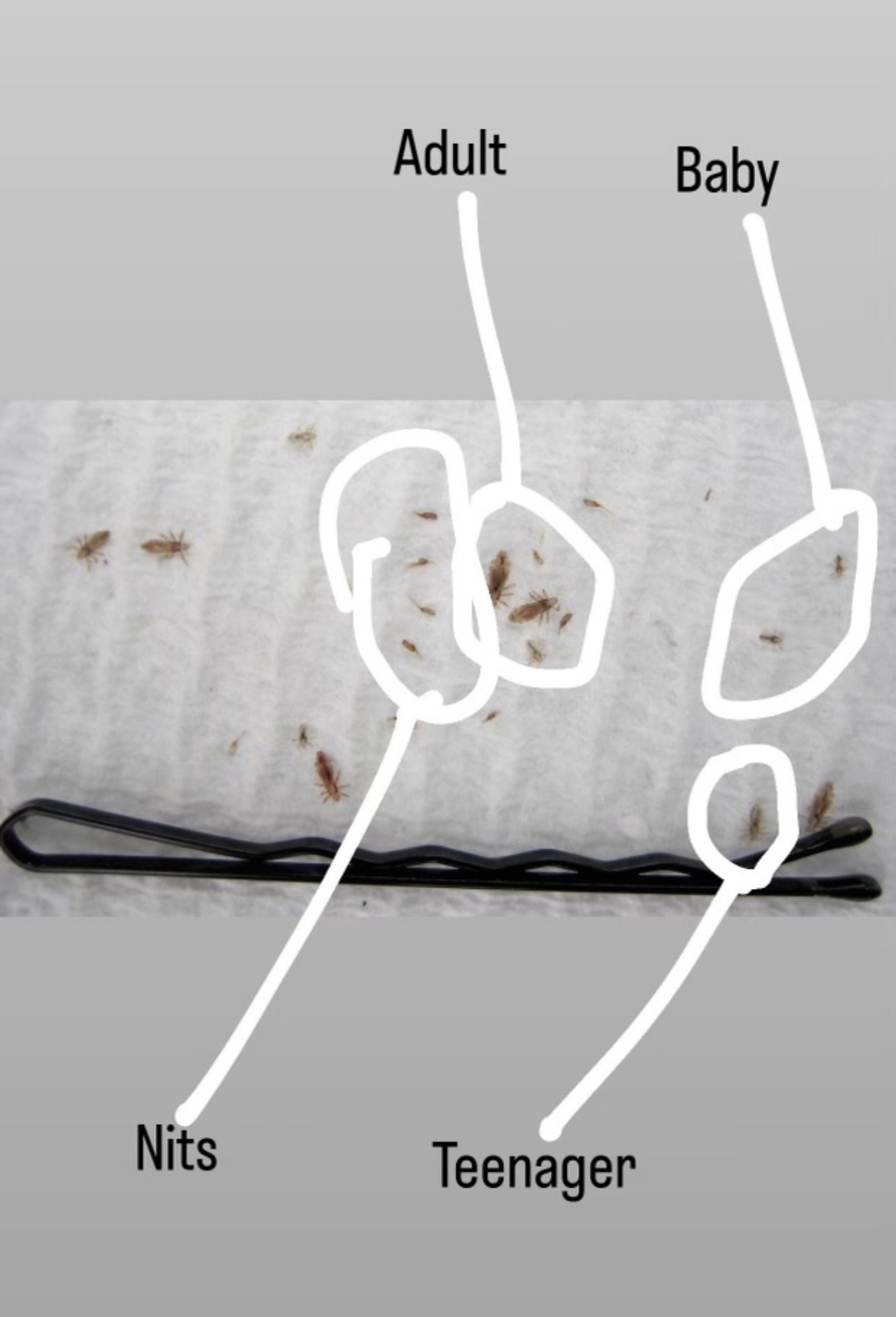 Lice and nits examples to help families identify what they are seeing