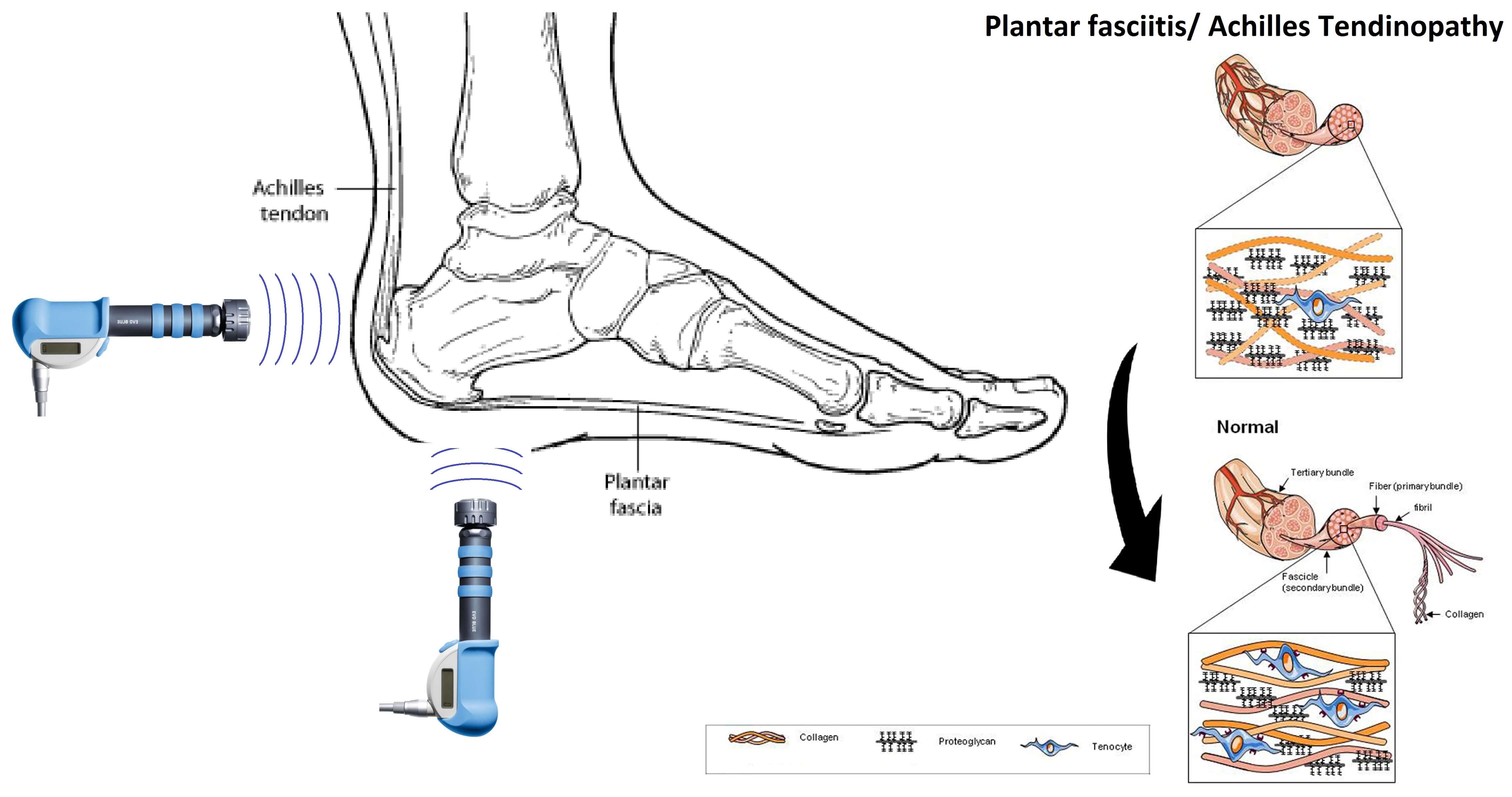 plantar-fasciitis-shockwave