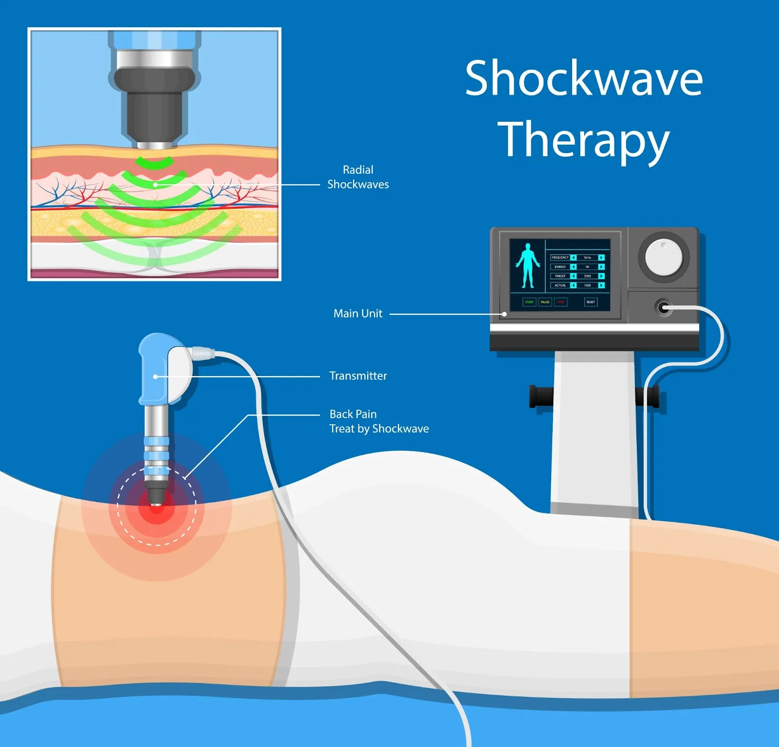 back pain shockwave therapy
