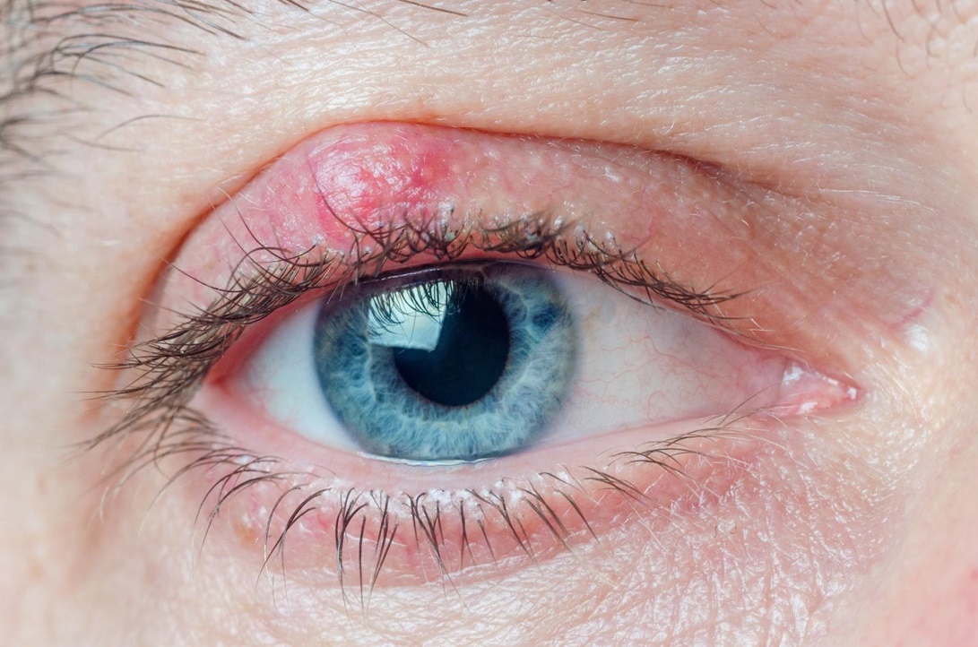 Chalazion Treatments: A Tailored Approach to Chalazion Relief