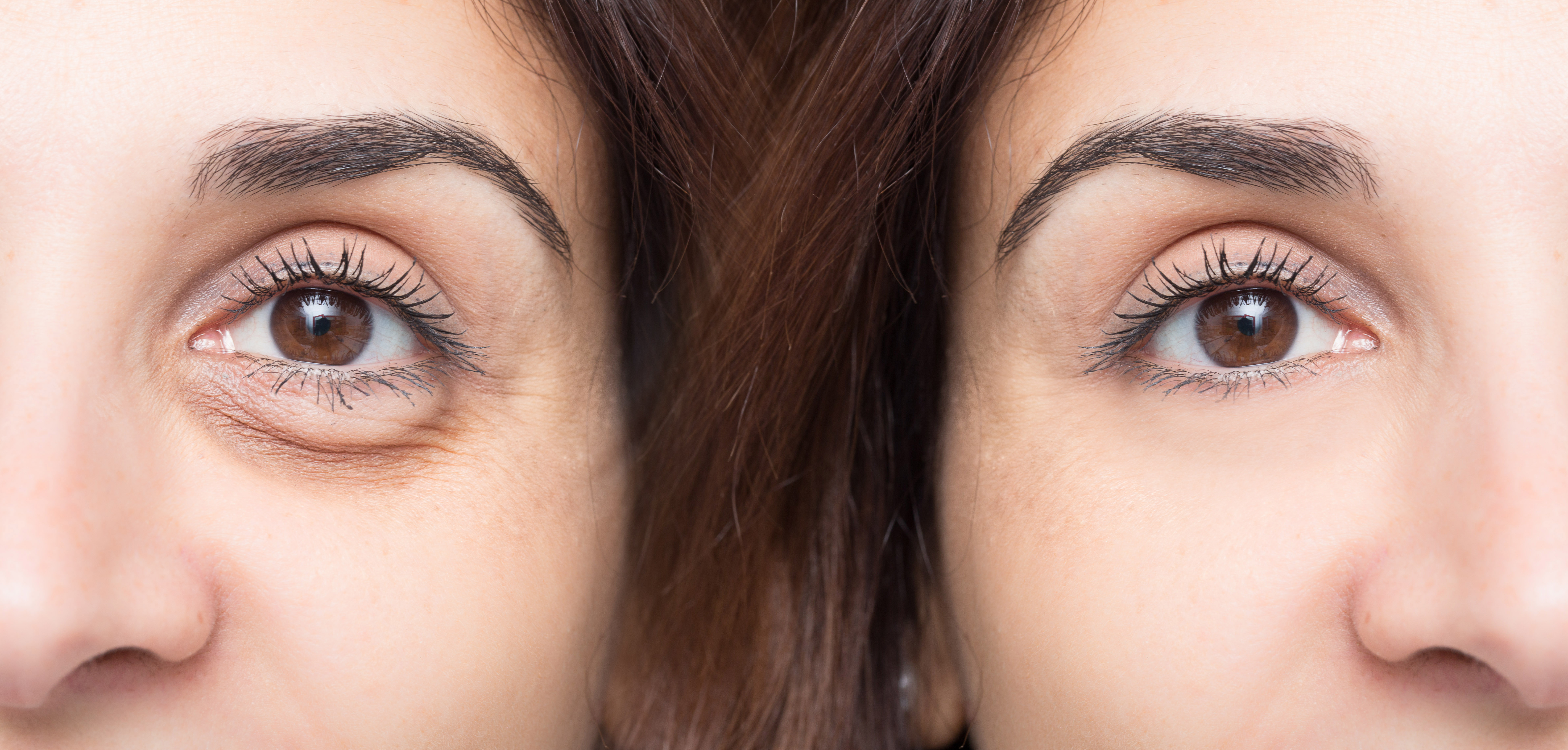 Thinking About Eyelid Surgery (Blepharoplasty): 5 Things to Keep in Mind