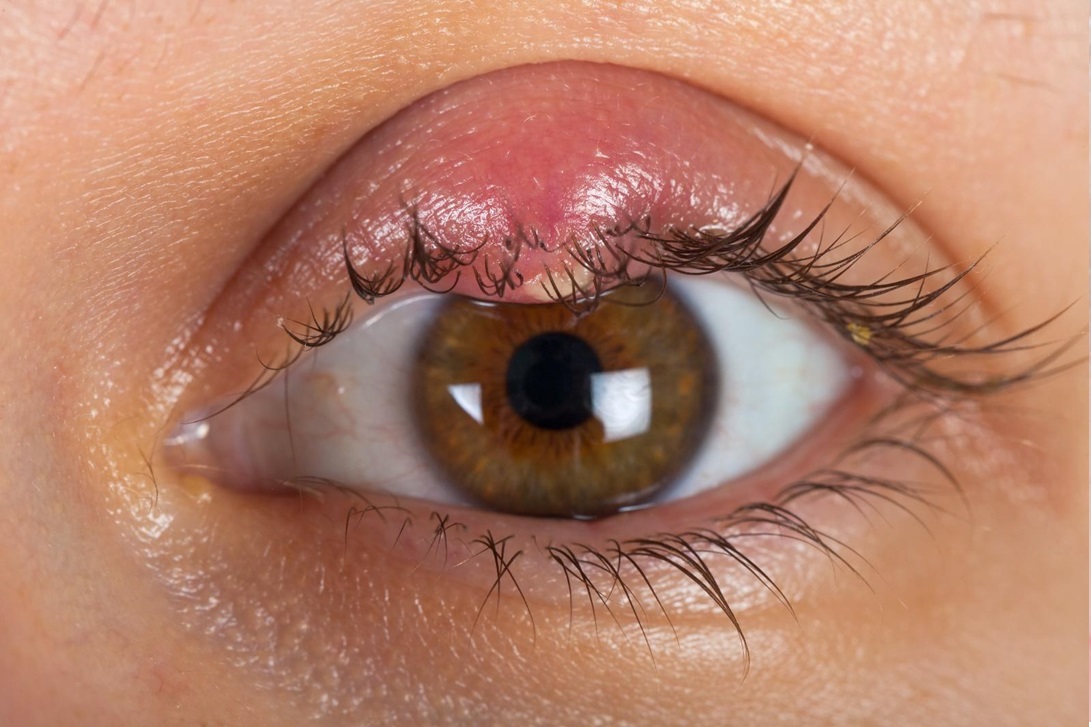 Understanding Chalazion: A Common Eyelid Bump
