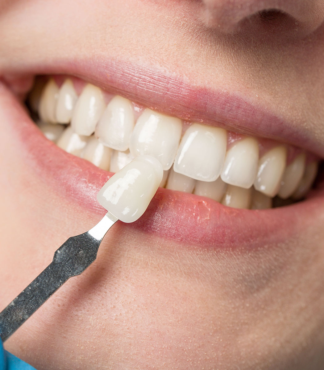 Clear Aligners