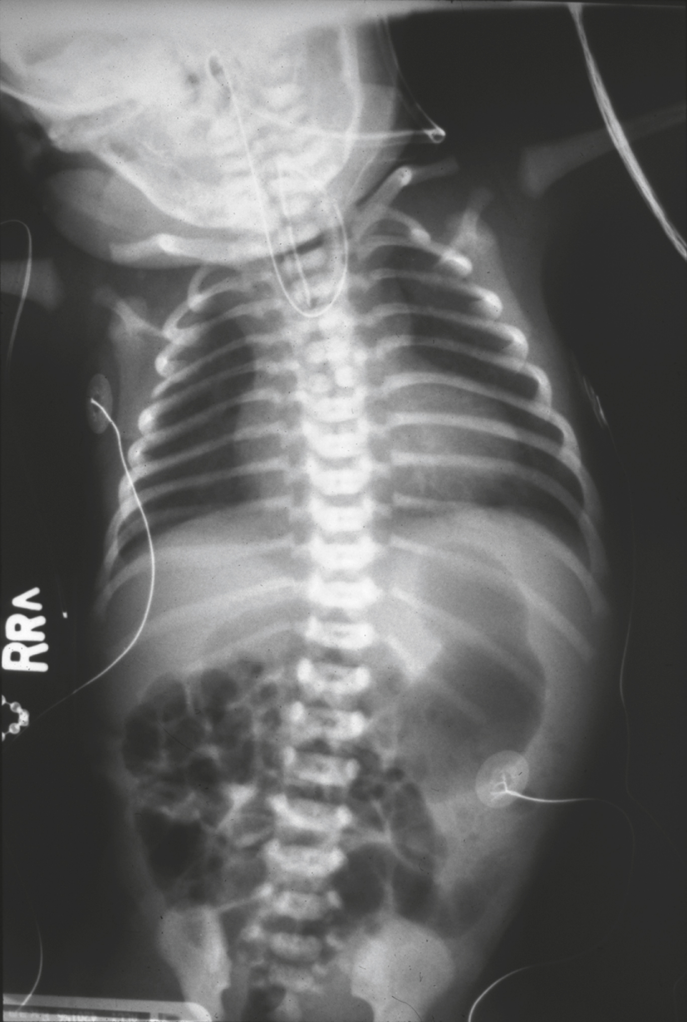 TEF Xray