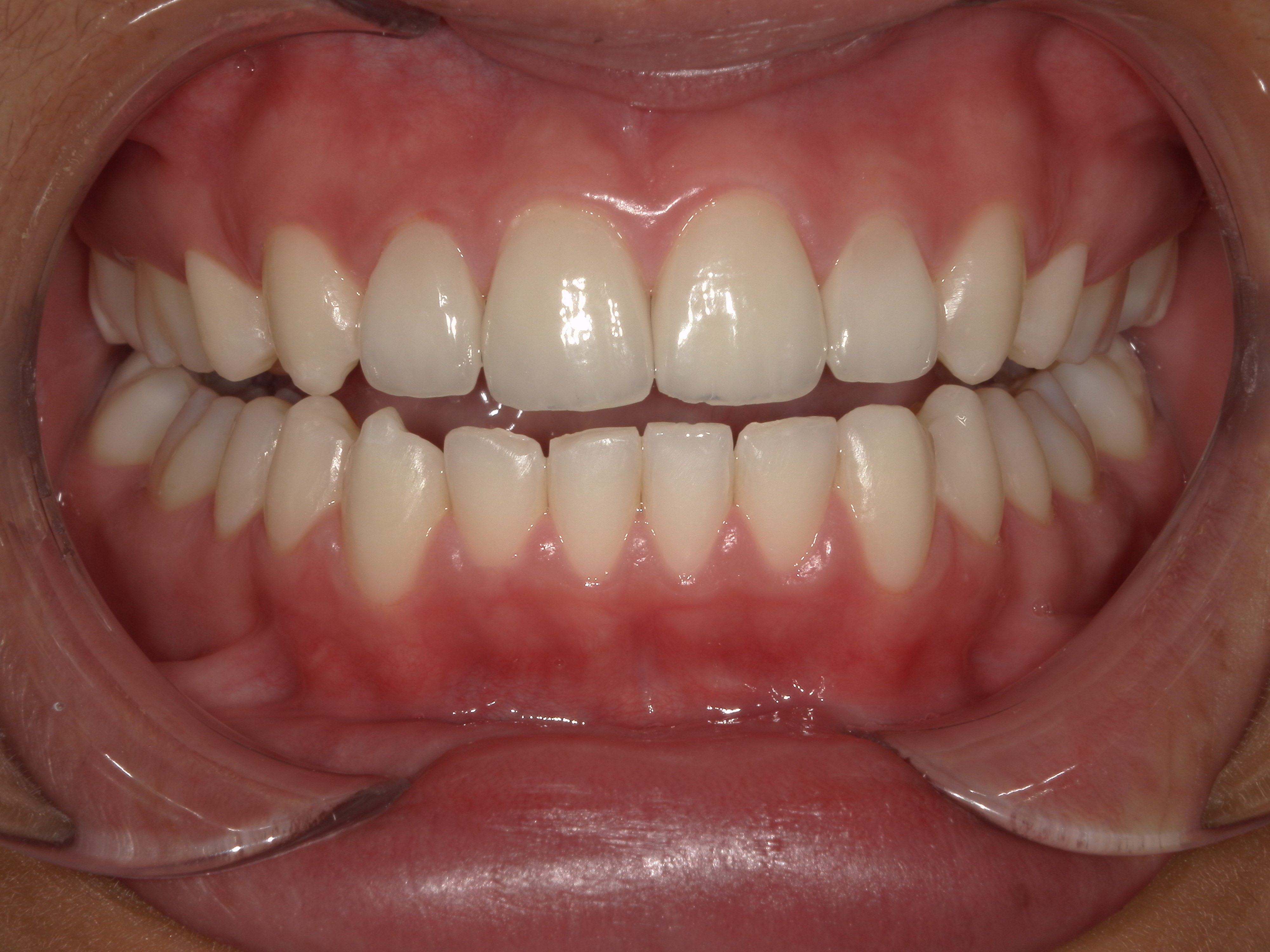 Case 1 After