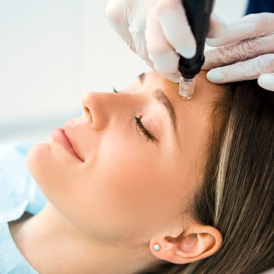 patient receiving tiny needle microneedling procedure