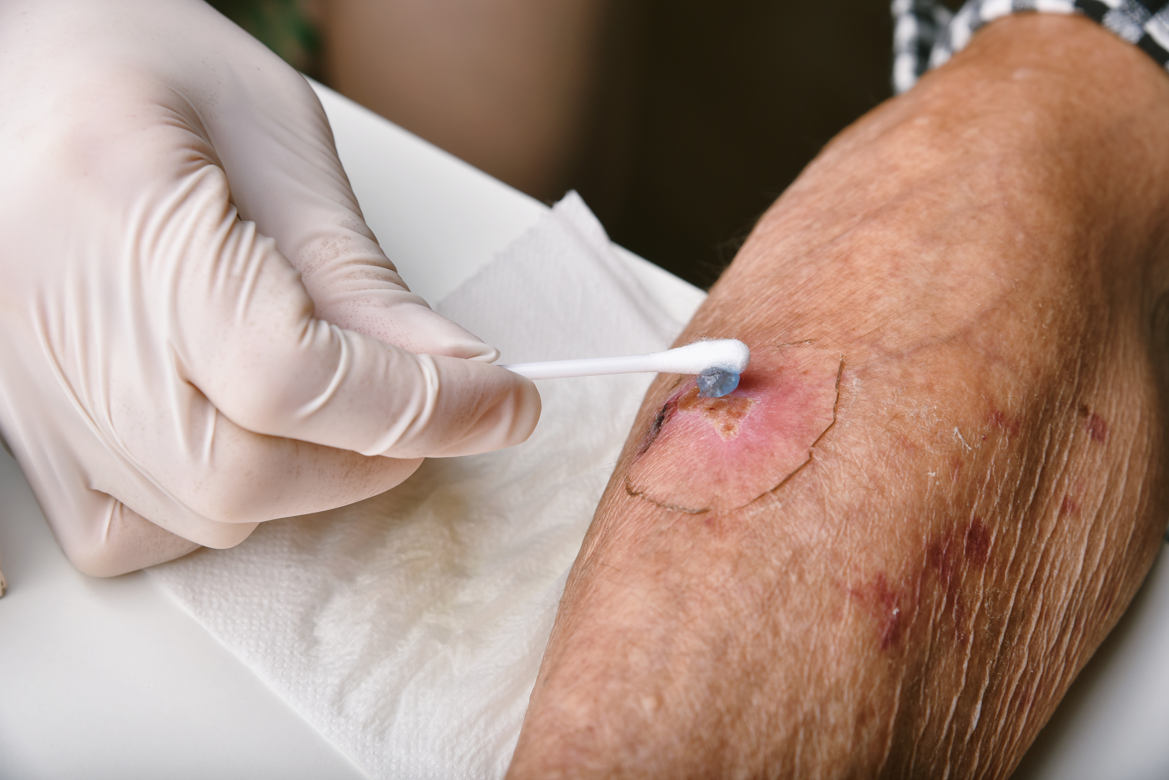Doctor applying medicine and dressing to an infected wound on a senior diabetic patient at Royal Wound Care – specialized treatment for chronic wounds in elderly individuals. Doctor applying medicine and dressing to an infected wound on a senior diabetic patient at Royal Wound Care – specialized treatment for chronic wounds in elderly individuals.