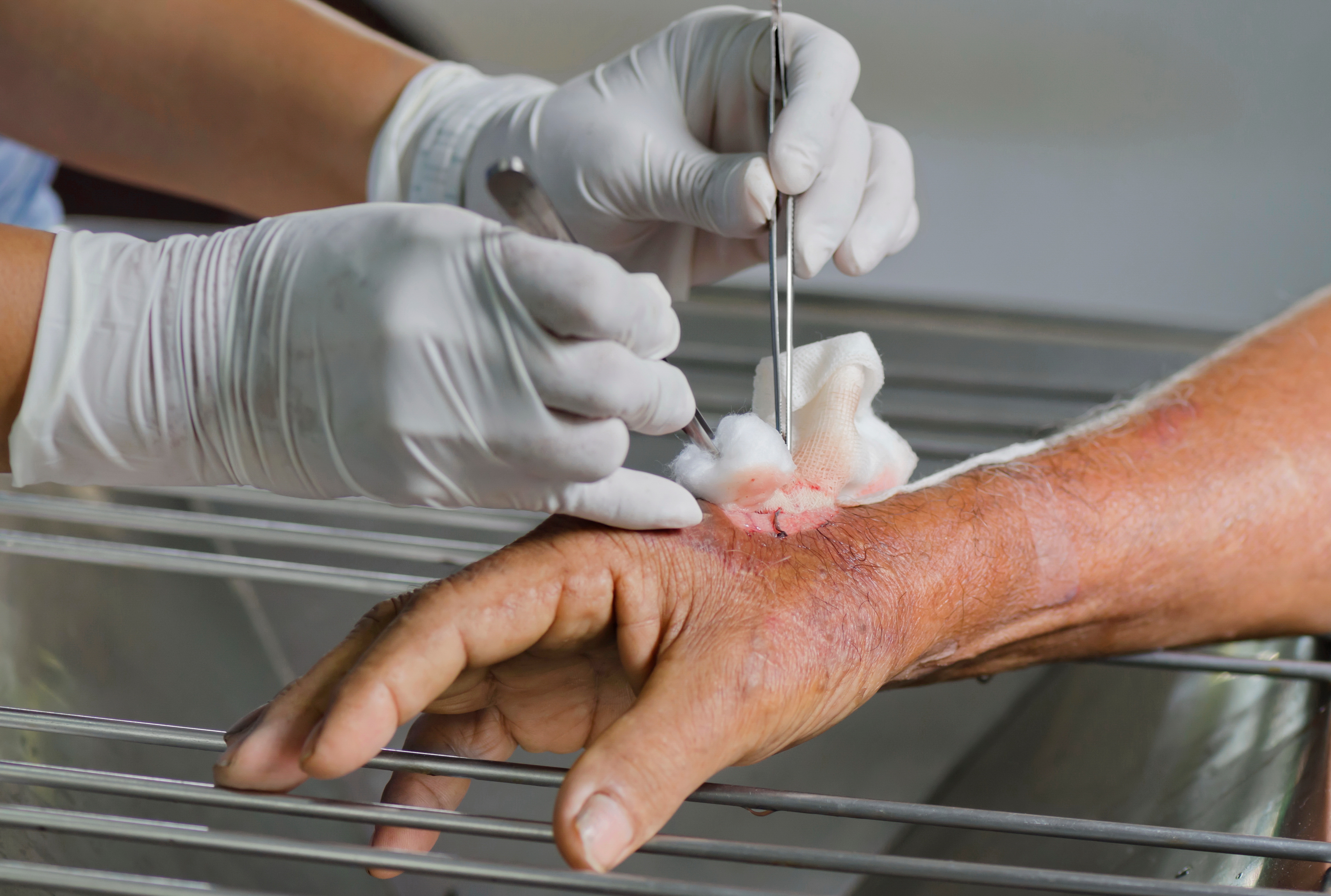 Close-up of wound cleaning and debridement on an elderly patient’s hand by a medical professional at Royal Wound Care – advanced treatment for infected and chronic wounds. Close-up of wound cleaning and debridement on an elderly patient’s hand by a medical professional at Royal Wound Care – advanced treatment for infected and chronic wounds.